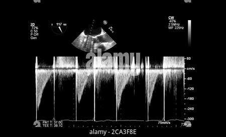 Image du cœur en mode échelle de gris pendant l'échographie transœsophagienne. Banque D'Images