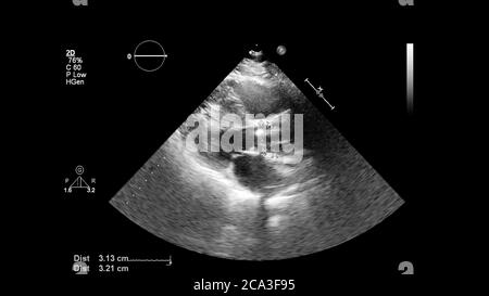 Image du cœur en mode échelle de gris pendant l'échographie transœsophagienne. Banque D'Images