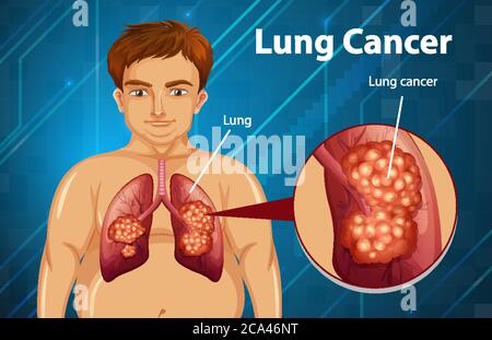 Illustration informative du cancer du poumon Illustration de Vecteur