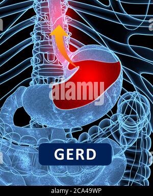 Reflux acide, GERD. Reflux gastro-oesophagien. Estomac et digestif. Anatomie humaine. illustration 3d Banque D'Images