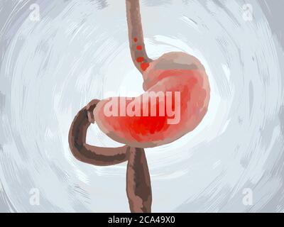 Reflux acide, GERD. Reflux gastro-oesophagien. Estomac et digestif. Anatomie humaine. illustration 3d Banque D'Images