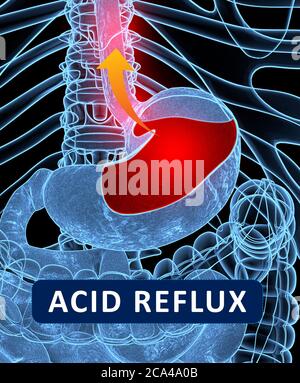 Reflux acide, GERD. Reflux gastro-oesophagien. Estomac et digestif. Anatomie humaine. illustration 3d Banque D'Images