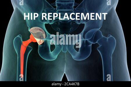 Illustration médicale précise du remplacement de la hanche. illustration 3d. Banque D'Images