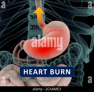 Reflux acide, GERD. Reflux gastro-oesophagien. Estomac et digestif. Anatomie humaine. illustration 3d Banque D'Images
