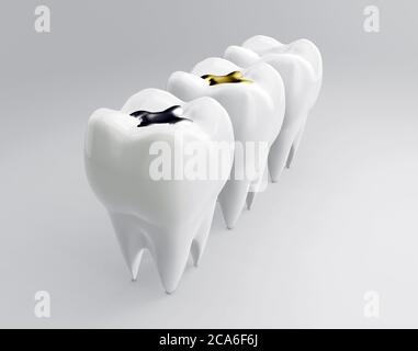 Dents en or, amalgame et garniture dentaire d'incrustation composite. Molaires sur fond blanc. Différents types de remplissages, rendu 3d Banque D'Images