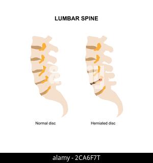 Illustration vectorielle de la colonne lombaire humaine montrant un disque lombaire normal et hernié. Illustration de Vecteur