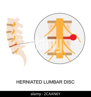 Illustration vectorielle montrant un disque lombaire hernié humain. L'hernie du disque lombaire peut causer des douleurs lombaires et de la sciatique Illustration de Vecteur