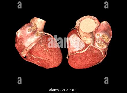 Vue latérale et supérieure de l'angiographie par TDM artère coronaire image 3D de rendu isolée ou arrière-groupe noir pour détecter une maladie coronarienne. Banque D'Images