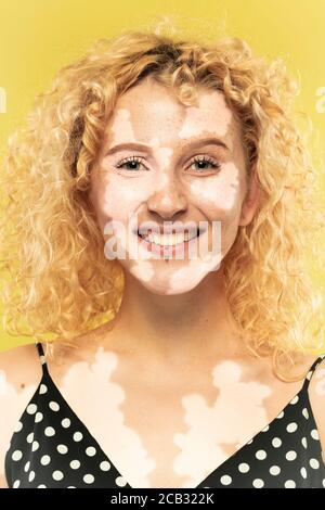 Portrait de la femme caucasienne avec peau de vitiligo. Peau spéciale avec dépigmentation en raison de la perte de mélanine. Concept de soins de la peau et de soins de santé, inclusion et diversité, mode et beauté. Banque D'Images