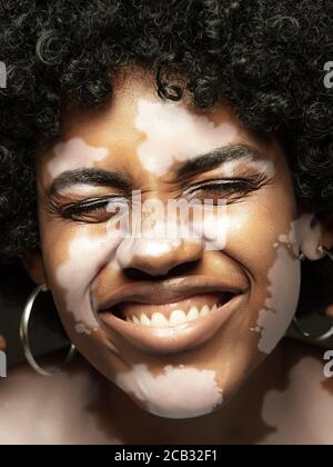 Portrait de femme afro-américaine avec peau de vitiligo. Peau spéciale avec dépigmentation en raison de la perte de mélanine. Concept de soins de la peau et de soins de santé, inclusion et diversité, mode et beauté. Banque D'Images