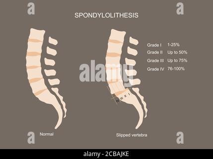 Illustration vectorielle de la colonne lombaire normale et de la vertèbre ou de la spondylolithèse. Degré de vertèbre glissée. Illustration de Vecteur