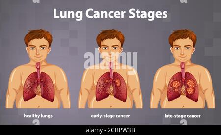 Illustration informative des stades du cancer du poumon Illustration de Vecteur