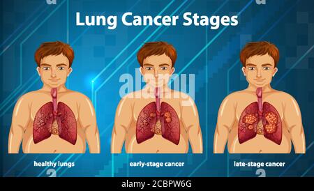 Illustration informative des stades du cancer du poumon Illustration de Vecteur