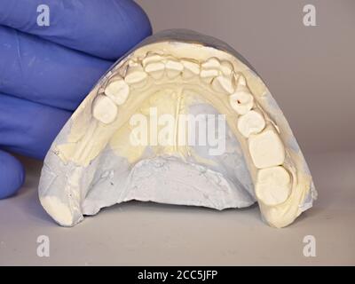 Moulage de matériaux dentaires. Modèle coulé montrant la carie dentaire en clinique dentaire pour le diagnostic et le traitement tenu dans la main stérile de gant de dentiste. Banque D'Images