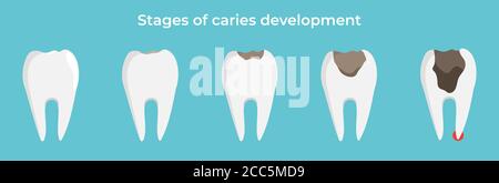 Étapes de développement de caries, dent dekay, concept dentaire, illustration vectorielle sur fond bleu. Illustration de Vecteur