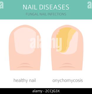 Maladies des ongles. Onychomycose, infections fongiques des ongles causes, jeu d'icônes de traitement. Conception d'infographies médicales. Illustration vectorielle Illustration de Vecteur