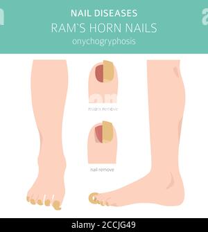 Maladies des ongles. Onychogryphose, clou de corne de RAM. Conception d'infographies médicales. Illustration vectorielle Illustration de Vecteur