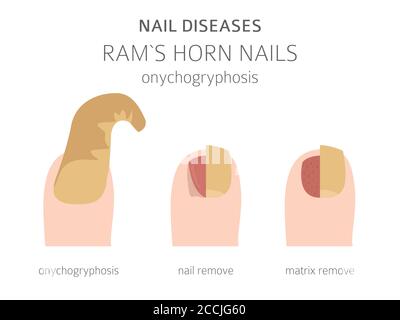 Maladies des ongles. Onychogryphose, clou de corne de RAM. Conception d'infographies médicales. Illustration vectorielle Illustration de Vecteur