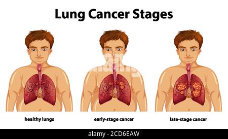 Illustration informative des stades du cancer du poumon Illustration de Vecteur