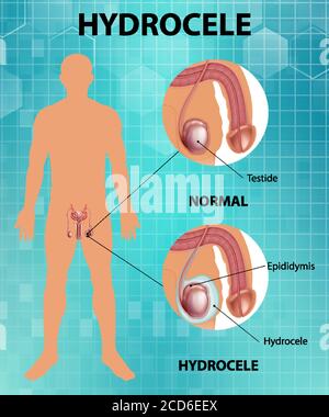 Affiche médicale montrant différents entre le testicule normal mâle et l'hydrocèle illustration Illustration de Vecteur