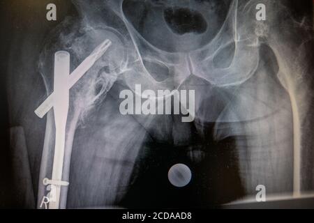 Rayons X d'une hanche avec un clou fémoral implanté Banque D'Images