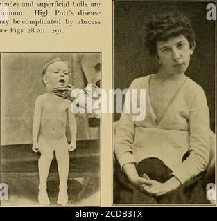 . Diagnostic physique . ONS, le cancer de l'estomac et le sarcome de thelung ont causé l'élargissement de ces glandes dans les cas sous myobservation. (g) si la glande parotide seule est gonflée et qu'il y a de la fièvre et des douleurs à la mastication, le cas est probablement l'un des oreillons, surtout si d'autres cas se trouvent à proximité. Une affection maligne peut s'attaquer à la parotide. (h) la rougeole allemande peut être accompagnée d'un gonflement des glandes cervicales ou occipitales posterelles sans implication de toute autre. 32 DIAGNOSTIC PHYSIQUE II Abcès ou cicatrices. Abcès ou cicatrices sur les côtés et devant le cou généralement re Banque D'Images