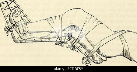 . Manuel de petite chirurgie . Fig. 182. moyenne articulée à charnière et de deux planches, lunefemoral, lautre jambière, qui glissent à laide de coulisses dansune planchette moyenne ; Cette disposition permet dallonger oude raccourcir lappareil suivant la chaleur du membre brasé.un écrou fixe la cale mobile à la planchette moyenne ;sur les parties latérales des planches tibiale et jambière setrouvent des anneaux dans lesquelette moyenne ;sur les parties laterales de planchettes tibiale et jambière setrouille repart ; enfin chach planchette is per-cée à chacun de ses angles dun trou qui permet de suspendendrelap Banque D'Images