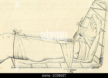 . Manuel de petite chirurgie . Figure 174. remplissent bien les indications : this sout presque les seulesqui soent employed aujourdhui.. Figure 175.la figure 173 présente une gouttière de fil de fer: la APAREILS UNE EXTENSION DE M. BAUDENS. 257 figure 17-i, une autre coutière coudée dans la lacelle sur un plaché lebras et lavant-bras; la jambe (fig. 175), la cuisson des gaz analogues. Nous avons pennés que cestrois gouttières suffient pour représenser la forme et les usugesde ces appareils. l 2. - Boites, elles diffusent des gouttières en ce qui se présente un fon Banque D'Images