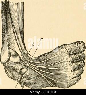 . Le traitement chirurgical des difformités communes des enfants . il traitementde la difformité, a naturellement causé plus d'attentionpour être donné à la condition dans laquelle ils s'abstinent, que même à la forme des os ou de la thecontraction des ligaments. Il peut être pris que ce sont les tendons qui sont en défaut, car dans le club-pied congénital il est rare de trouver les muscles dans autre qu'une condition de santé. Il arrive parfois, cependant, le club-pied est associé à l'arrêt de développement de certains muscles, comme dans les cas décrits par M. Adams. Les tendons ont principalement affecté moi Banque D'Images