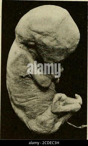 . Une étude des causes sous-jacentes à l'origine des monstres humains : troisième contribution à l'étude de la pathologie des embryons humains . Figure 316a.—vue avant de l'embryon. Légèrement agrandi.. Banque D'Images