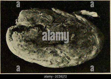 . Une étude des causes sous-jacentes à l'origine des monstres humains : troisième contribution à l'étude de la pathologie des embryons humains . Figure 279.—Photographie d'une section de l'échantillon montrant la cavitéset la corde à l'intérieur. Légèrement réduit. 274 MALL. [Vol XIX et un millimètre de diamètre; il y a aussi des numérivaisseaux dans les villosités du chorion. Le tissu de l'hyaline chorionis, avec un nombre réduit de noyaux dans celui-ci. Sans aucun doute le fœtus s'est échappé d'une certaine manière peu avant l'avortement, les membranes et le cordon restant un peu de temps, assez longtemps pour subir ces changements. Le système de divertissement vidéo Blood Banque D'Images