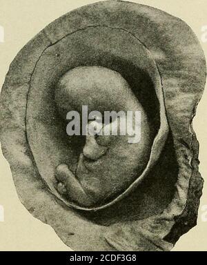 . Une étude des causes sous-jacentes à l'origine des monstres humains : troisième contribution à l'étude de la pathologie des embryons humains . T---1J Banque D'Images