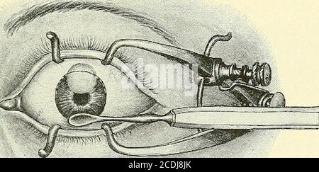 . Chirurgie, ses principes et la pratique . moyens d'un ascenseur de couvercle, ou un assistant devrait soulever le spélumumde sorte que ses lames ne doivent pas appuyer sur le globe oculaire et pourtant soulever les thelides loin de l'oeil. La surface convexe d'une cuillère en métal est maintenant appliquée contre la partie inférieure de la cornée, et une pression ferme mais douce est exercée, ce qui fait apparaître la marge supérieure de la lentille dans l'espace de la pupille. Comme la cataracte glisse à travers la pupille dans la plaie thespoon est fait pour le suivre avec un mouvement doux vers le haut qui déversla lentille et en même temps enlève de petits fragments de corte Banque D'Images