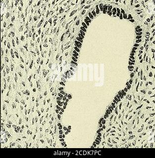 . Gynécologie : . d ne pas atteindre une taille aussi grande. La signification clinique des kystes séreux dépend beaucoup de la question de savoir s'ils sont papillomateux. La variété non papillaire est généralement bénigne et ne réapparaît pas après l'opération, mais il est possible qu'un cystoma apparemment non papillarycystoma puisse se reproduire rapidement sous forme cancéreuse, la croissance papillaire ayant été ex-istée au microscope dans la paroi de la tumeur originale. 396 GYNÉCOLOGIE les tumeurs papillaires sont d'une importance clinique plus grave en raison de la tendance plus grande à la dégénérescence maligne, et en raison de la possibilité d'implantation du papill Banque D'Images