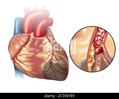 Illustration montrant un cœur sain (petit) et une plaque dans l'artère coronaire, un caillot sanguin (thrombus) se décomposant et bloquant le flux sanguin (infarctus cardiaque Banque D'Images