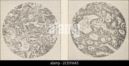 . Virginia médicale semi-mensuelle . Figure 1. Photographie de la surface antérieure-inférieure du cervelet, montrant la tumeur in situ, soulevé légèrement froits lit en enveloppant un peu de coton dans la cavité derrière elle, afin d'afficher les vaisseaux de la membrane piale, cette membrane couvrant l'ensemble de la surface enterrée de la tumeur, ayant été porté devant elle pendant theprogress de sa croissance. La bordure intérieure est toujours fixée par les membranes, les vaisseaux, etc. Le sur-face exposé est généralement rugueux par son détachement de la dura, dont il crache. Le déplacement latéral des pons et de la médulla Banque D'Images