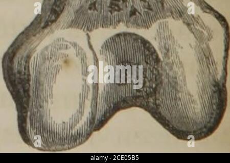 . Un traité pratique sur les fractures et les dislocations . Fracture de la tige du fémur; unitedavec un calus oblique. D'un échantillon dans l'armoire des auteurs. RÉPARATION DES OS CASSÉS. 49 l'os d'une cuisse de dindes ainsi unis par un arbre poney transversal, bien que séparé de plus d'un pouce, et ce qui est moins commun, Ipossèdent également un spécimen de la cuisse adulte humaine dans laquelle un obliqueshaft de calus solide a, après de nombreux mois, et bien qu'aucune spintswere n'ait été employée, a attaché ensemble fermement les deux extremesopposés de l'os brisé. Sixièmement, les fragments se chevauchaient plus ou moins et souffrent Banque D'Images