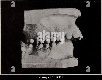 . Journal de l'Institut de Stomatologie de New York, American Academy of Dental Science, Harvard odontological Society et le Metropolitan District (Mas . l'hérédité pon doit nous étudier les causes de mal-occlusion. Les causes de mal-occlusion être-ing dû à des changements d'environnements, nous devrions étudier les conditions qui sont normales et produisent la normale, et toute déviation doit être noté avec ses effets sur les dents. Nous savons tous en- 158 LE JOURNAL. Terference avec la respiration normale dans la croissance de l'enfant producesformes définies de mal-occlusion et de défiguration définitive de la ligne faciale, d'autres definii Banque D'Images