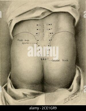 . Anesthésie régionale : son application technique et clinique . le domaine opératoire; mais, comme déjà indiqué, les cas d'échec à produire l'anesthésie par le biais du bloc caudal seul et la thésowness avec lequel l'anesthésie se met, a suggéré l'utilisation de sa itassociation avec le bloc transsacré. Le bloc sacré induit de la même manière que pour l'urétromie externe(page 413) est la procédure effectivement recommandée pour l'hemorrhoidec-tomy, ainsi que pour les fissures dans l'ano, le prolapsus rectal et le rectal Pol&gt;-p. RÉSECTION POSTÉRIEURE DU RECTUM le contrôle de l'élément psychique du patient est ici du Banque D'Images