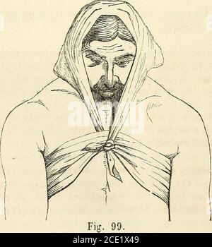 . Manuel de petite chirurgie . Figure 98.bien sûr. Elle-ci sige-t-elle en avant, la tête sera tenue dans. n lAÀGLES. 167 le même sens par un triangle dont la base sera placé sur lesommet de la tête, à ne pas faire passer les deux chefs en avantde que côté du cou et fixé sur une césure qui embrala partie supérieure de la poiterrine en passant sous les aisselles(tig. 99). La mauvaise pression siége-t-elJQ à la partie supérieure du cou,le bandage sera appliqué en sens inverse, cest-à-dire le plein- Banque D'Images