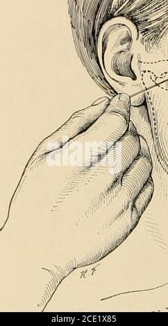 . Anesthésie régionale : son application technique et clinique . Bloc mandibulaire par voie extra-orale (1). 2. L'aiguille n° 3 (8 cm) est insérée immédiatement sous le point médian de l'arche zygomatique et introduite transversément à travers les tissus mous (Fig. 67) jusqu'à ce qu'il atteigne le processus ptérygoïde du sphènoïdbone, à environ 5 cm de son point d'entrée. L'enregistreur avec lequel l'aiguille a déjà été fournie est amené au contact 96 ANESTHÉSIE RÉGIONALE. Banque D'Images