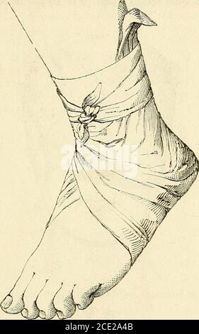 . Manuel de petite chirurgie . Fig. 9/1. lieu du membre, à ne pas replanter langle droit sur la plaque sur la partie supérieure du moion : les deux angles aigusviennent se croiser en avant et fixer langle droit (fig. 94). Ce bandage est commode, solude, et peut être exécuté et enlevésans que le malade éveille la moiré gène. OUI. Pqnnet py TALON.Pour Maintenir des topiques appli-. TRIANGLES. 163 qués sur le talon, on peut faire usage du bandage suivant: placezle plein du triangle sous la plante du pied en avant du talon, croi-. TIG. 95. sez et fixez les deux chefs sur le cou-de-pied ; r Banque D'Images