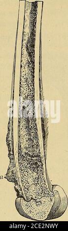 . Traité de chirurgie clinique et optique . Figure 195. Dégénecence cancéreuse dune trabécule osseuse. Grossissement500 diamètres (Rindfleisch, Histologie). Le plus souvent le carcinome primitif est circonscrit et intraosseux,mais le carcinome franchit rapidementla barrière osseuse (fig. 193 et suivantes).par contre, les cartilages articulaires lui. Banque D'Images