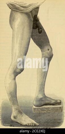 . Traité de chirurgie clinique et opatratoire . consquenceépiphysaires,épiphysaires,diaphysoiresdes fractures (fig. 89 la métallisation existante de la lostéite aumoun osséux juxtaépiphysaioremobilize lépiphyse, si des lampes osseuses sous-pensées en abondance ne vien-nent pas servir dattelle existant. Mais habituement cetedisjonction nid que temporaireet une virole périph sert àfixer les os. La pesanteur, les contractuellesdusculaires peuvent determinerlaffaiblement, la déformationdun segment du squelette. Par-fois, quand il y a eu un col Banque D'Images