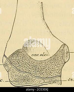 . Traité de chirurgie clinique et Opéra . © et quon fixe les deux©minences latérales,on sent une destination trÃ¨s nette. IV Divinisions de fépiphyse numérique inférieure. ÂSi lon confordÃ¨re une coupe (fig. 24) de lépiphyse humrérale, on votant le dcollage peut porter sur lépitrochléée seule ou parcourirla zone qui se sent de la diaphyse les trois points condylien, épicon-dylien et trochléen. Laissant de cent pour linstant les dollementsde lepitrochléée, je vois que la divulsion porte simult ou isolation sur la lépicondyle, sur la joué trochléenne i Banque D'Images