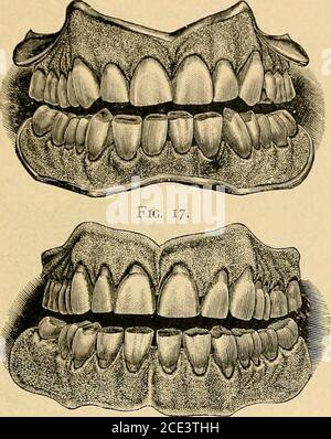 . Un manuel de la dentisterie mécanique et de la métallurgie . se produit occasionnellement à l'inexpérimenté, et devrait leur proveto une leçon saine. Il est toujours préférable, comme nous l'avons déjà suggéré, d'essayer les dents dans la bouche pendant qu'elles sont encore sur la plaque de cire, quand n'importe quelle imperfectionpeut être facilement corrigée. Façonner les arêtes de coupe.—lors de l'articulation des dents, en particulier celles de la partie antérieure de la bouche, il est souvent conseillé de couper et de façonner les arêtes, car elles ne peuvent être reconnues comme les mêmes dents. Prenez, par exemple, une personne du tempérament sanguin. La nature donne un tel Banque D'Images