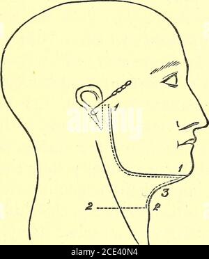 . Un manuel de dissection du corps humain [ressource électronique] : pour l'utilisation des étudiants et plus particulièrement pour ceux qui se préparent aux examens supérieurs de l'anatomie . plaque de rygoide. 3. Se trouvant sur la précédente artère pharyngée ascendante, en divisant en les branches suivantes: — suivant le tendon du muscle Tensor palati,un passant sur la bordure supérieure du muscle SuperiorConstrictor, un autre vers le Laceratedforamen moyen, et parfois un vers le Condy-loïde antérieur. Une dissection pour exposer l'HypoglossalNerve dans la partie extra-crânienne de son cours. Position.—le corps Banque D'Images