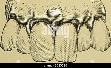 . Orthodontie, ou mauvaise position des dents humaines; sa prévention et remède . est, une grande partie de la substance ne devrait pas être enlevée et la surface devrait ensuite être polishedin la manière la plus parfaite. L'auteur a eu un cas, et un seul, dans lequel suchtailler des surfaces approximées semblait souhaitable. Le patient était une jeune femme d'environ vingt et un ans, dont les dents supérieures antérieures étaient légèrement proéminentes. Theteeth étaient sans espaces interdentaires et tous les jDosteriorones étaient si parfaits dans la structure, l'alignement et l'occlusion, que l'extraction de même d'un d'eux aurait beenr Banque D'Images