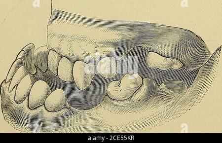 . Orthodontie, ou la malposition des dents humaines; sa prévention et remède . ornpendant plusieurs semaines de plus, sans tension accrue, à la reprise du résultat satisfaisant fixé. Il ne fait aucun doute que l'usure d'une plaque dans la mâchoire supérieure tlie arrangé avec le plan incliné, comme décrit, aidera matériellement à forcer la mâchoire inférieure vers l'arrière. Figure 147 illus-trats le mostf)ronouncedcase de cette classe 0 f deformatiesl'écrivain hasever rencontré.le patient wasa homme d'environ quarante ans et a été amené par un dentiste voisin pour la consultation que towhether tout pourrait être fait pour remédier à la TH Banque D'Images