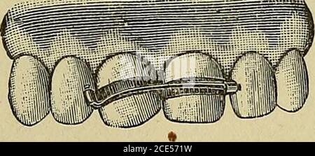 . Orthodontie, ou mauvaise position des dents humaines; sa prévention et son remède . Torsion de Centrals, witli i)i--til AnglesPointing vers l'extérieur. Plaque Ketainiiig sur le boîtier corrigé. Figure 116.. Figure 117. Banque D'Images